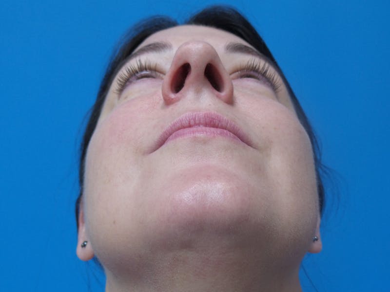 Rhinoplasty Before & After Gallery - Patient 191310 - Image 7