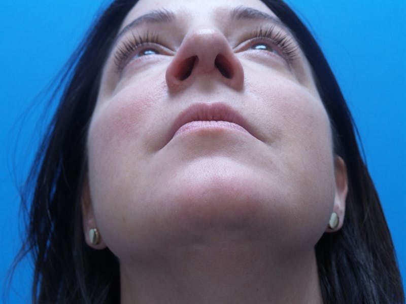 Rhinoplasty Before & After Gallery - Patient 191310 - Image 8