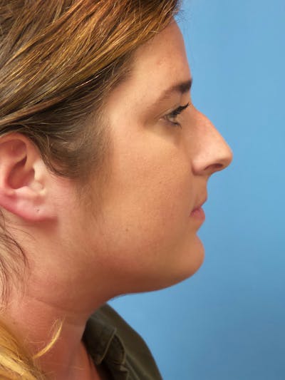 Rhinoplasty Before & After Gallery - Patient 179979 - Image 1