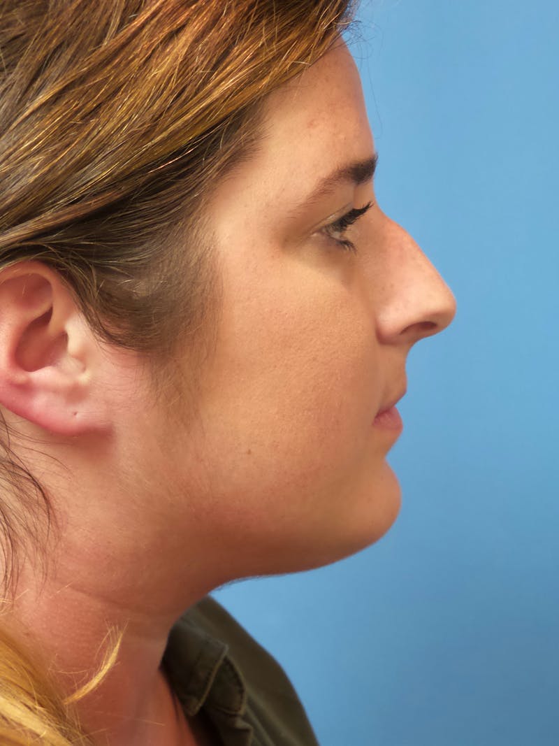 Rhinoplasty Before & After Gallery - Patient 179979 - Image 1