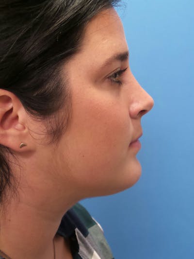 Rhinoplasty Before & After Gallery - Patient 179979 - Image 2