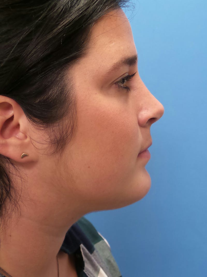 Rhinoplasty Before & After Gallery - Patient 179979 - Image 2