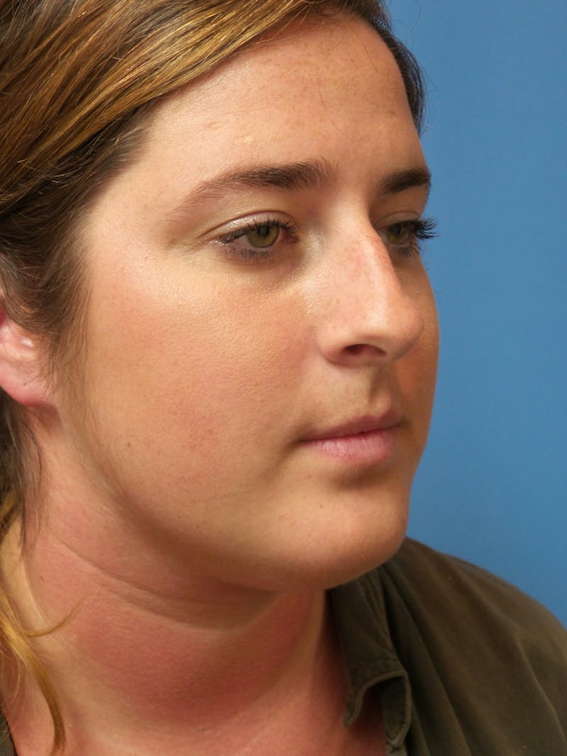 Rhinoplasty Before & After Gallery - Patient 179979 - Image 3