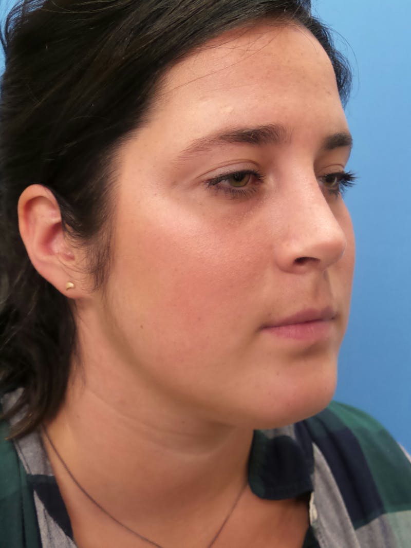 Rhinoplasty Before & After Gallery - Patient 179979 - Image 4