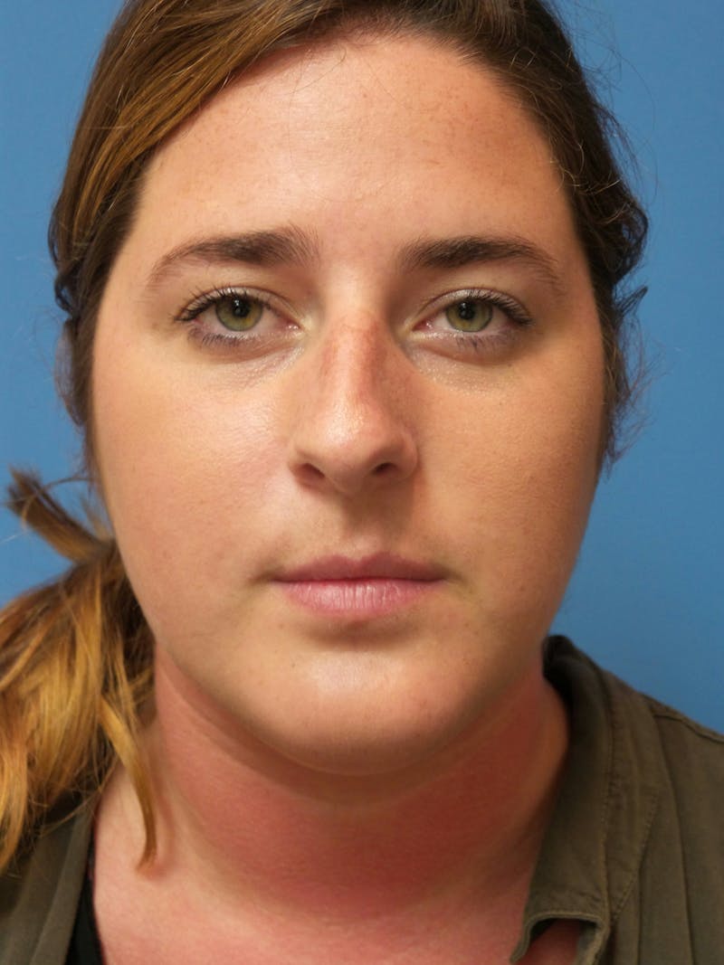 Rhinoplasty Before & After Gallery - Patient 179979 - Image 5