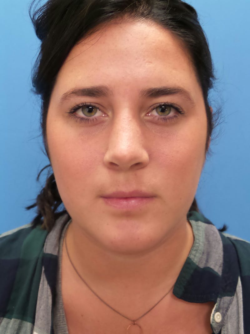 Rhinoplasty Before & After Gallery - Patient 179979 - Image 6