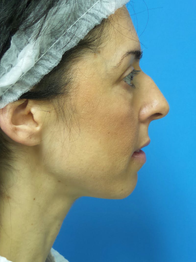 Rhinoplasty Before & After Gallery - Patient 407962 - Image 1