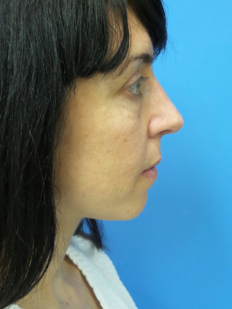 Rhinoplasty Before & After Gallery - Patient 407962 - Image 2