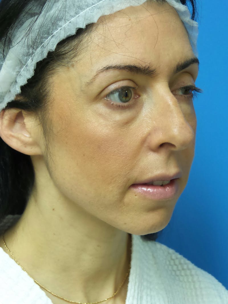 Rhinoplasty Before & After Gallery - Patient 407962 - Image 3