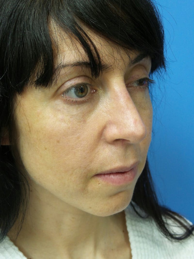 Rhinoplasty Before & After Gallery - Patient 407962 - Image 4