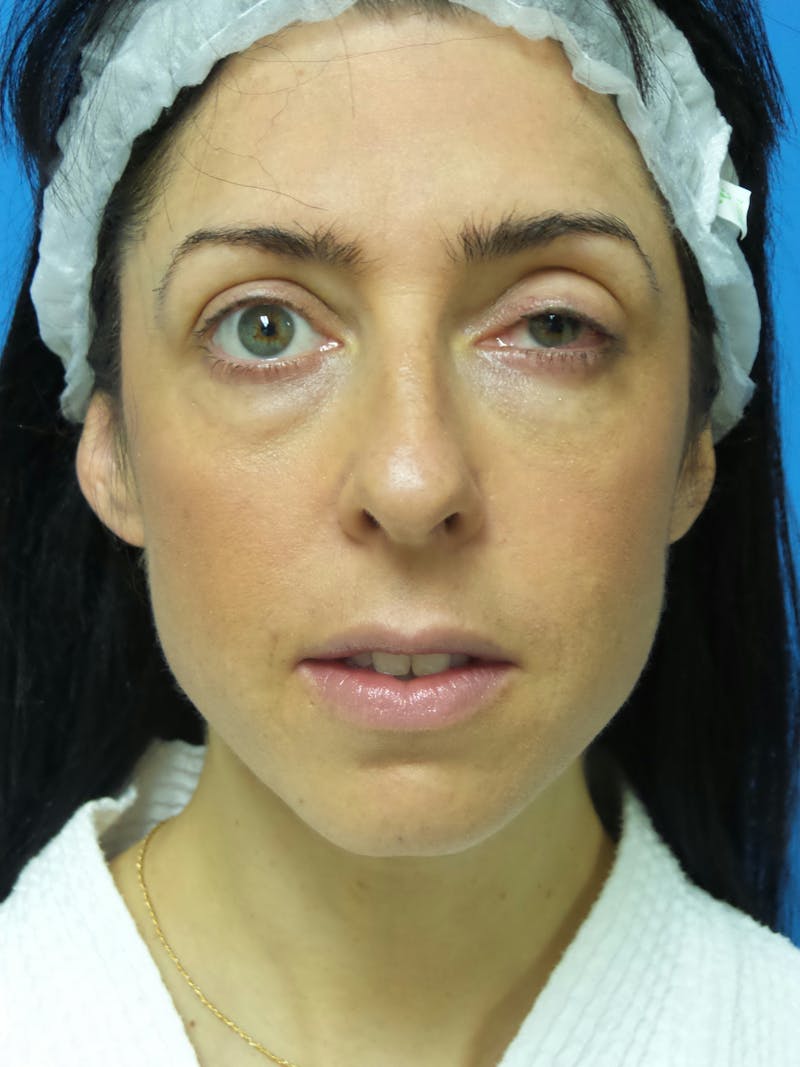 Rhinoplasty Before & After Gallery - Patient 407962 - Image 5