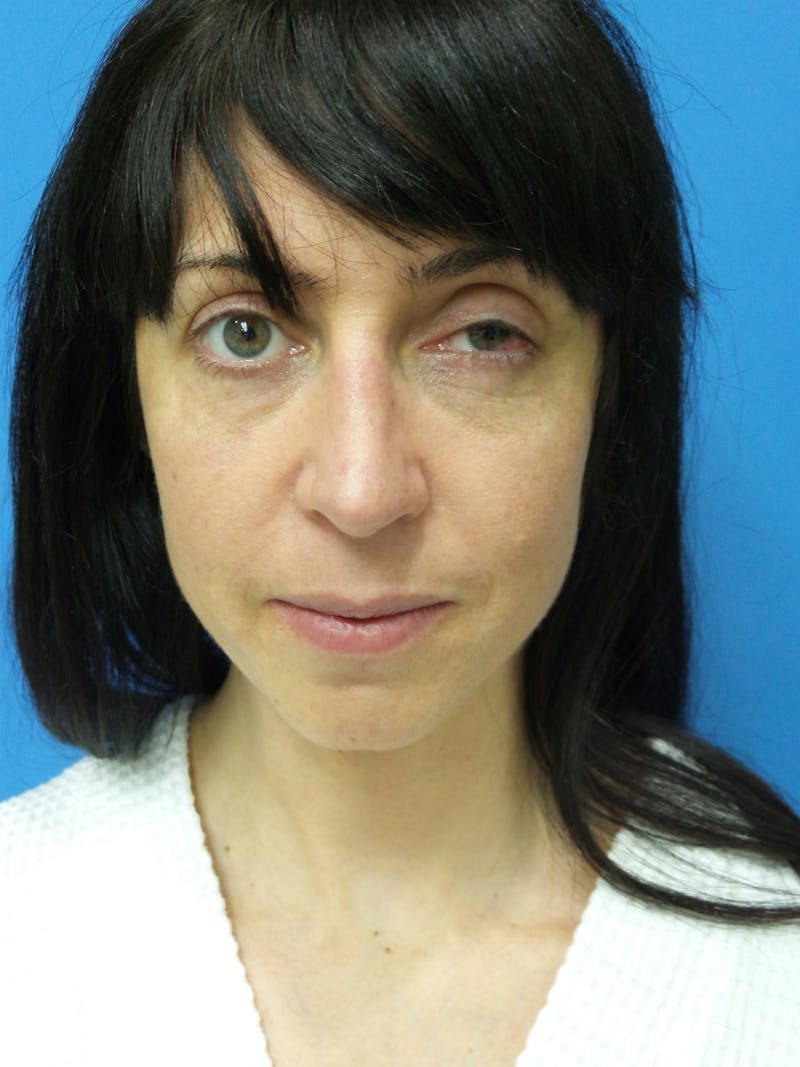 Rhinoplasty Before & After Gallery - Patient 407962 - Image 6