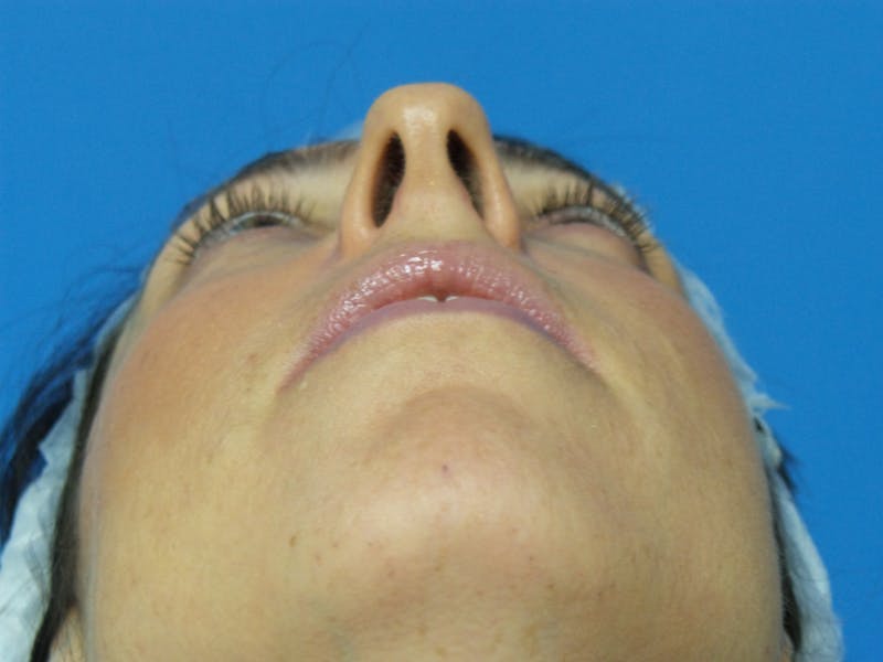 Rhinoplasty Before & After Gallery - Patient 407962 - Image 7