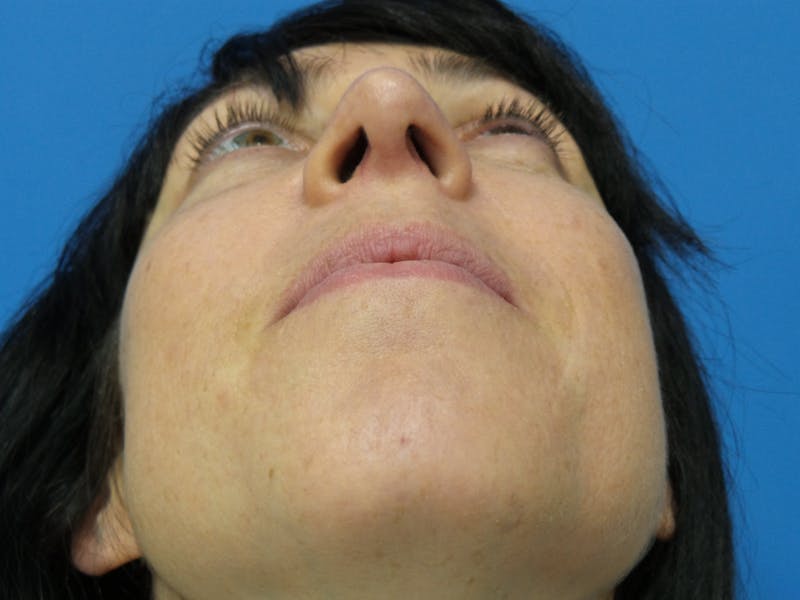 Rhinoplasty Before & After Gallery - Patient 407962 - Image 8
