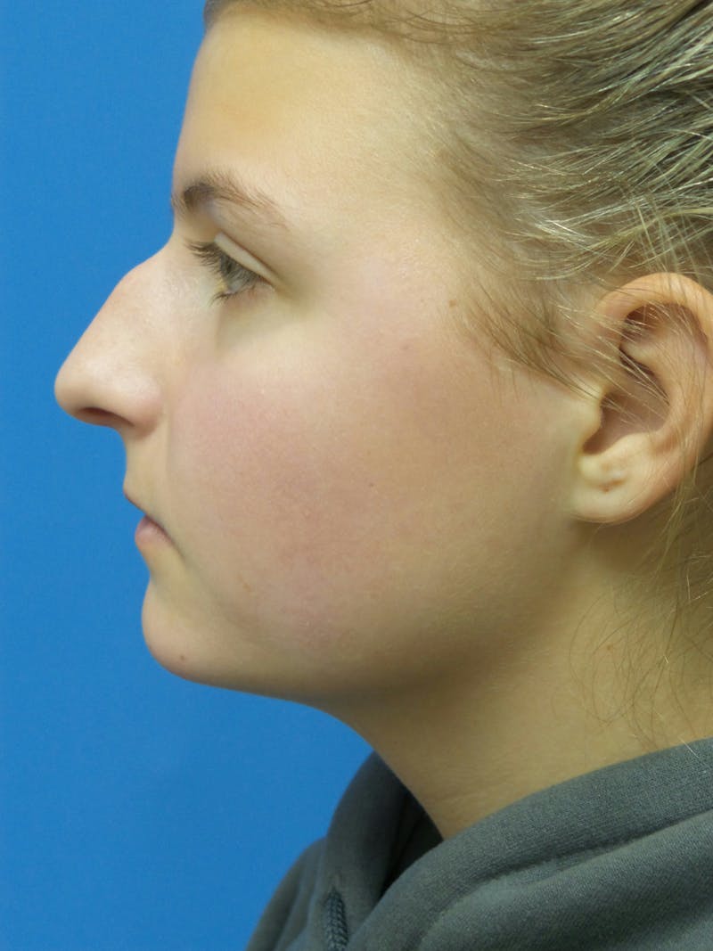 Rhinoplasty Before & After Gallery - Patient 183782 - Image 1
