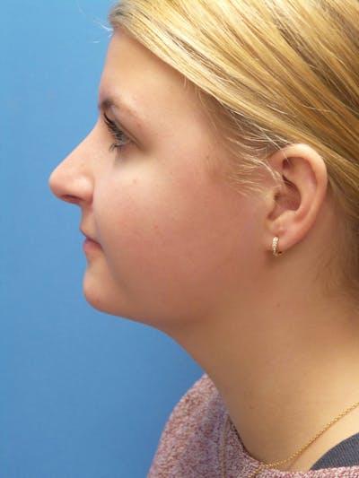 Rhinoplasty Before & After Gallery - Patient 183782 - Image 2