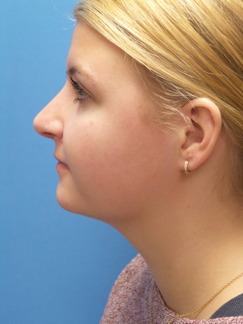 Rhinoplasty Before & After Gallery - Patient 183782 - Image 2