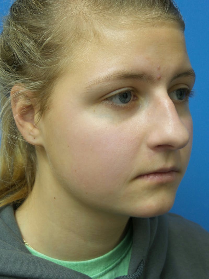 Rhinoplasty Before & After Gallery - Patient 183782 - Image 3