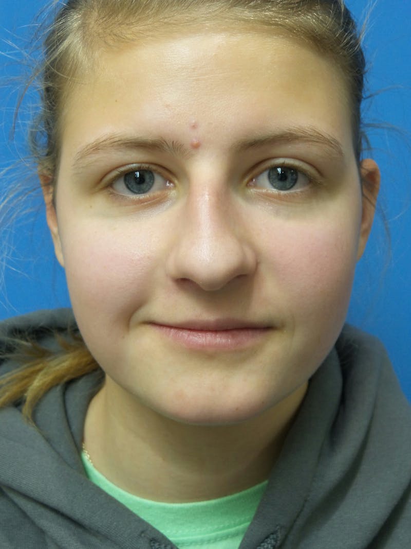 Rhinoplasty Before & After Gallery - Patient 183782 - Image 5