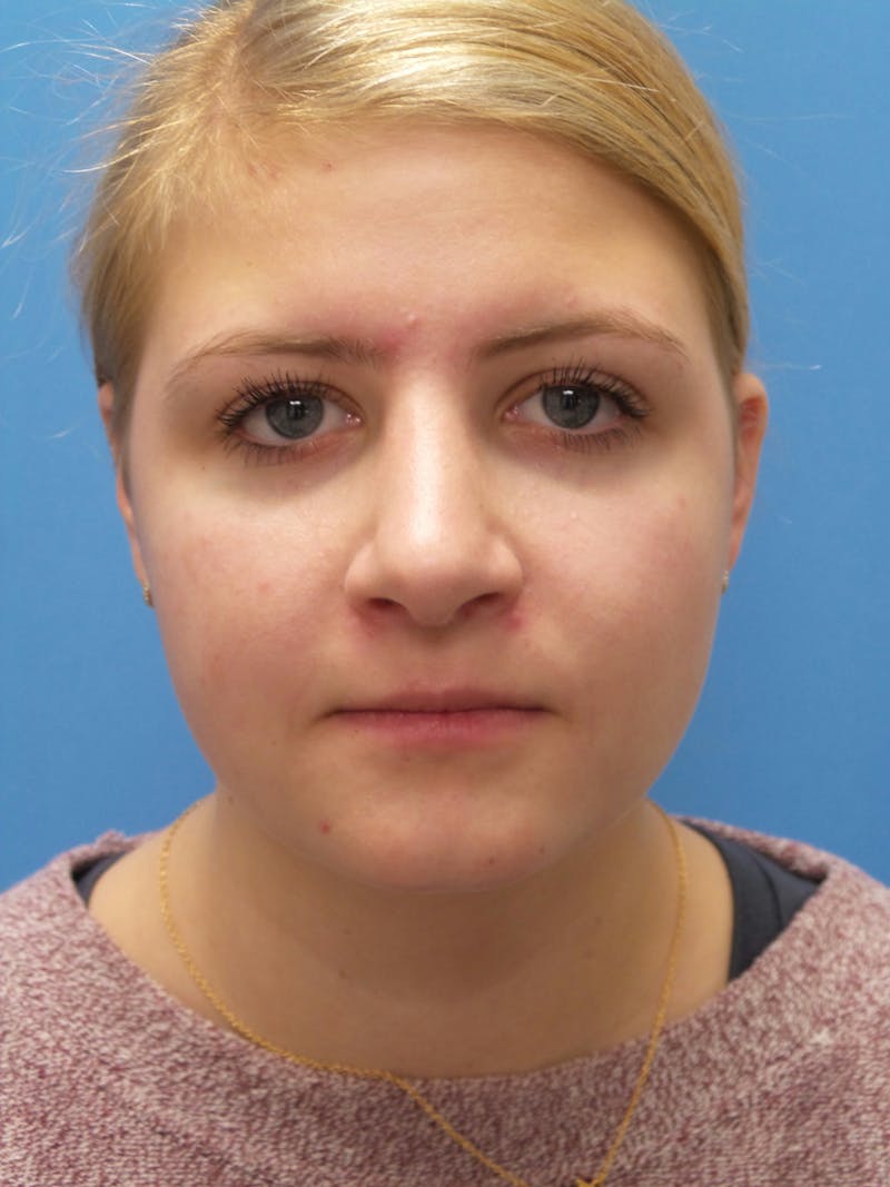Rhinoplasty Before & After Gallery - Patient 183782 - Image 6