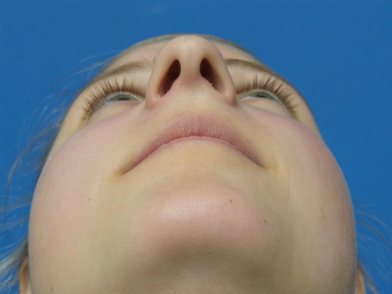 Rhinoplasty Before & After Gallery - Patient 183782 - Image 7