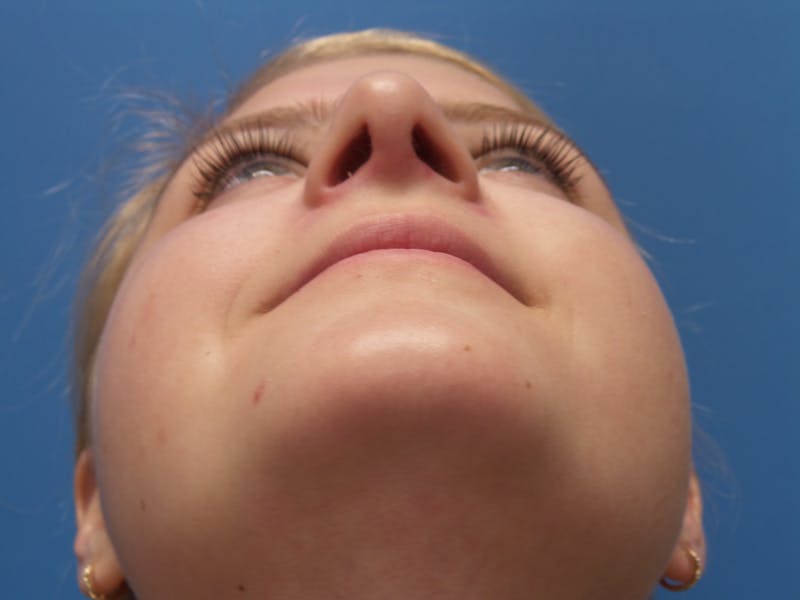 Rhinoplasty Before & After Gallery - Patient 183782 - Image 8