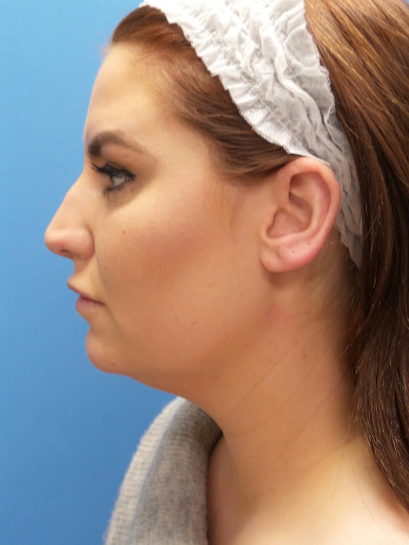 Rhinoplasty Before & After Gallery - Patient 308348 - Image 1
