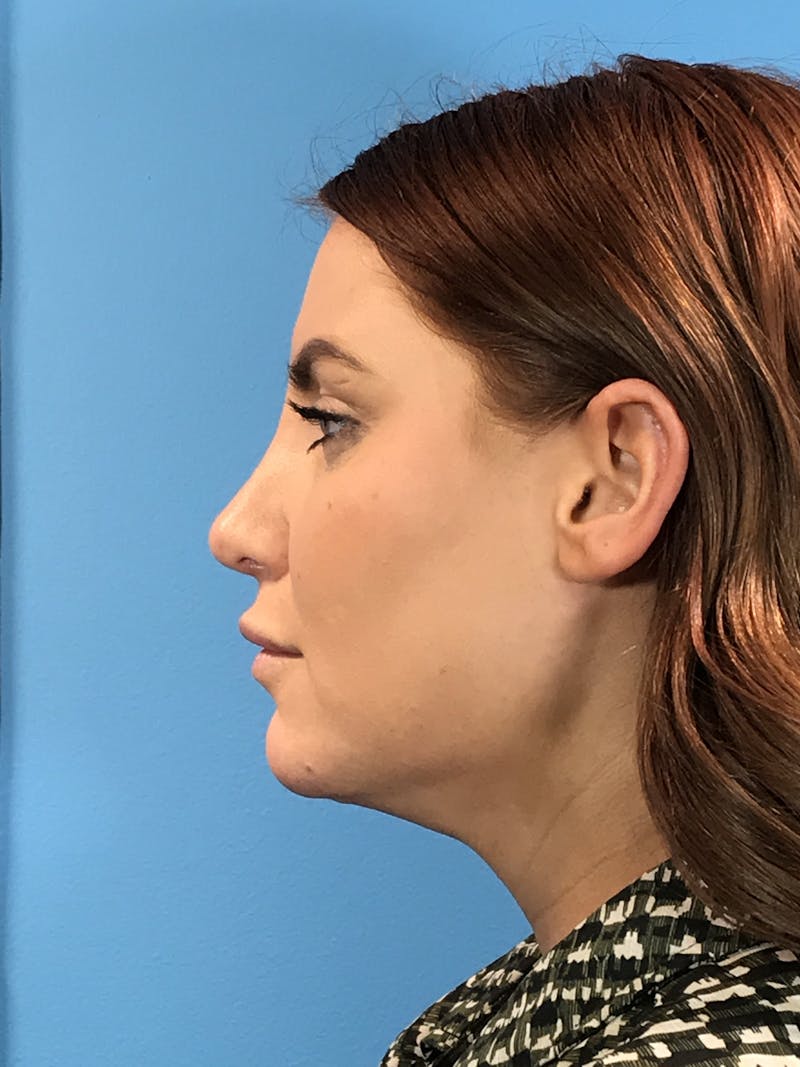 Rhinoplasty Before & After Gallery - Patient 308348 - Image 2