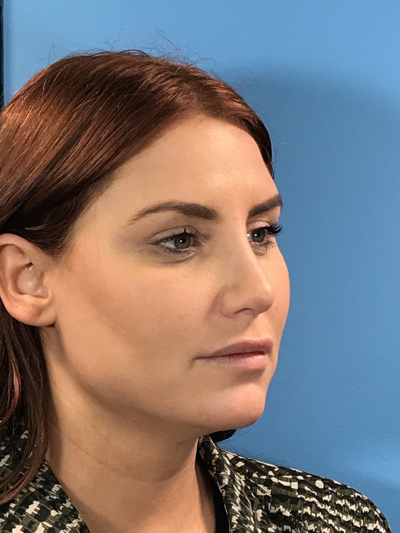 Rhinoplasty Before & After Gallery - Patient 308348 - Image 4