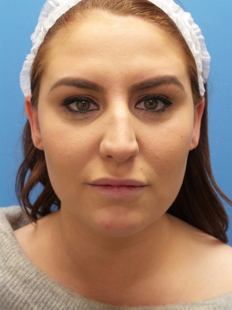 Rhinoplasty Before & After Gallery - Patient 308348 - Image 5