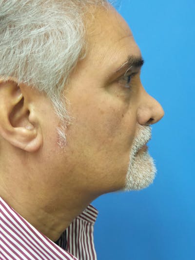 Rhinoplasty Before & After Gallery - Patient 405656 - Image 1