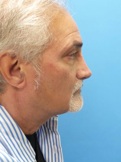Rhinoplasty Before & After Gallery - Patient 405656 - Image 2