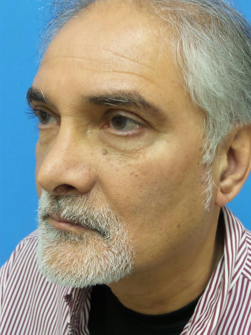 Rhinoplasty Before & After Gallery - Patient 405656 - Image 3