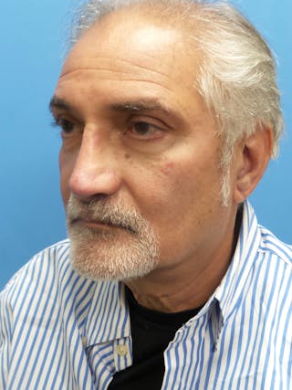 Rhinoplasty Before & After Gallery - Patient 405656 - Image 4