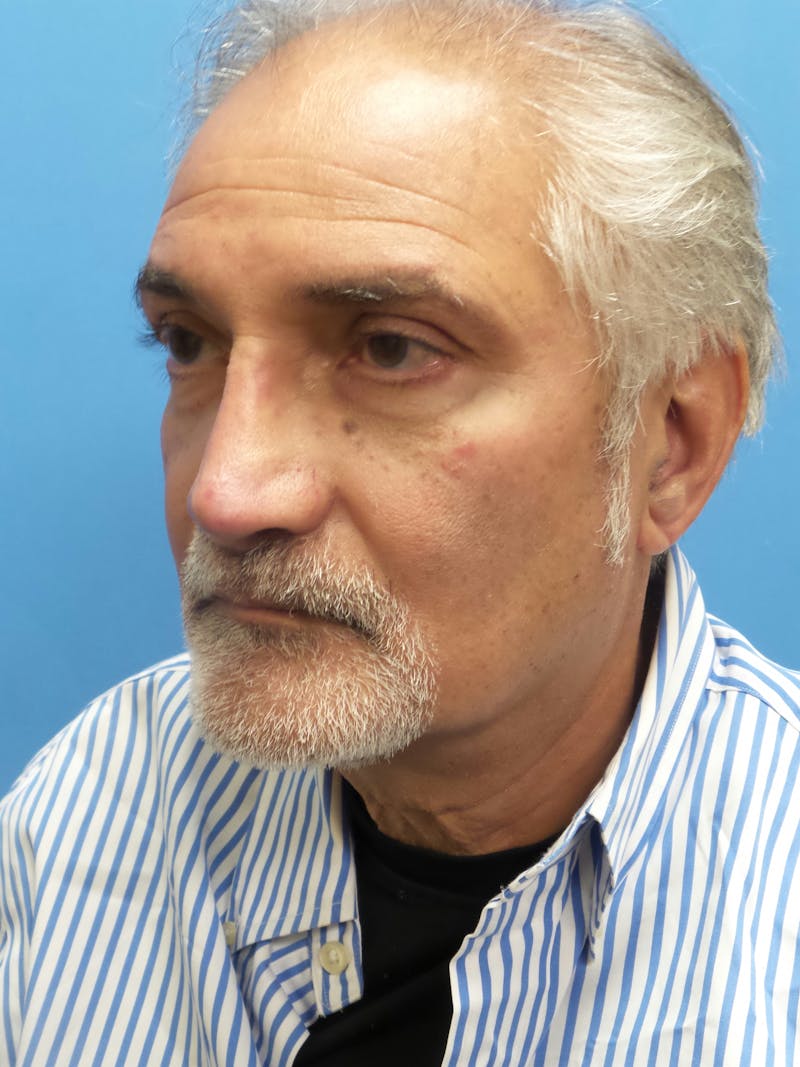 Rhinoplasty Before & After Gallery - Patient 405656 - Image 4