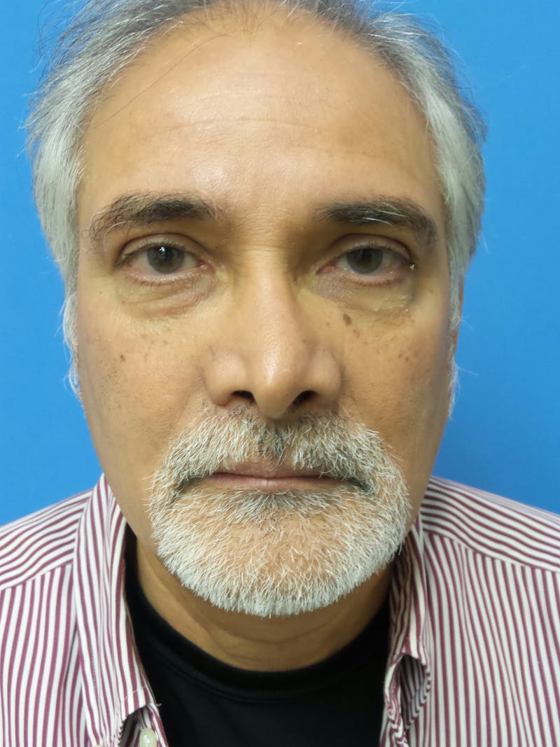 Rhinoplasty Before & After Gallery - Patient 405656 - Image 5