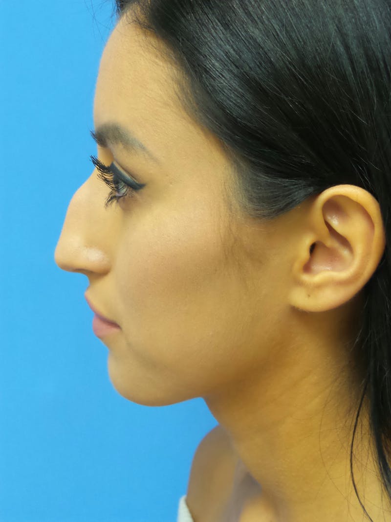 Rhinoplasty Before & After Gallery - Patient 102743 - Image 1