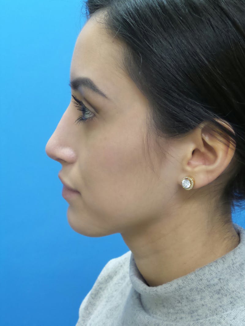 Rhinoplasty Before & After Gallery - Patient 102743 - Image 2