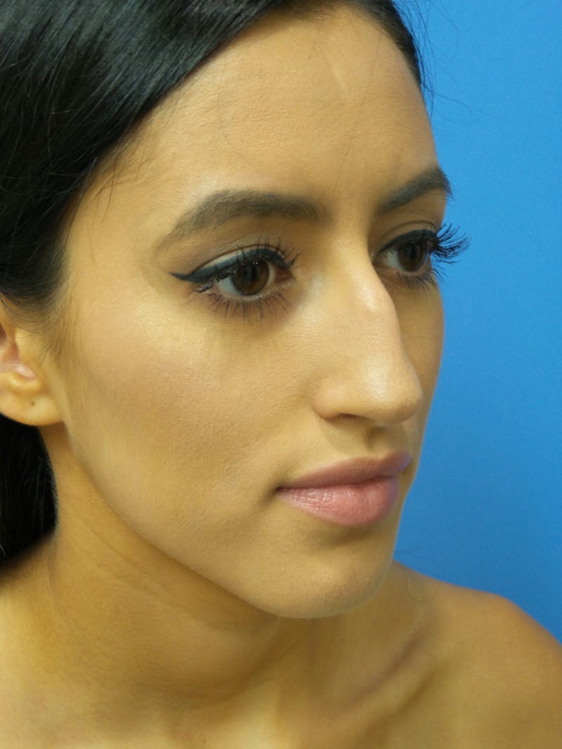 Rhinoplasty Before & After Gallery - Patient 102743 - Image 3