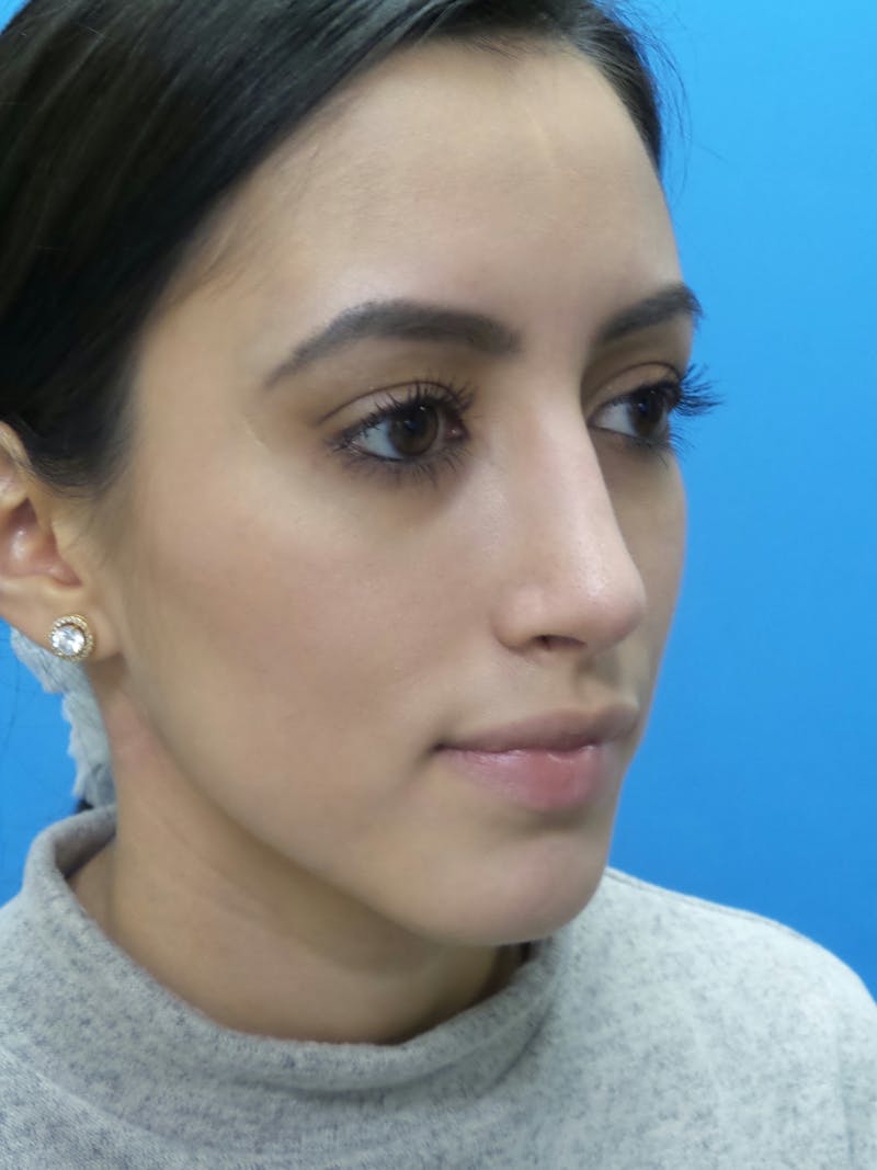 Rhinoplasty Before & After Gallery - Patient 102743 - Image 4