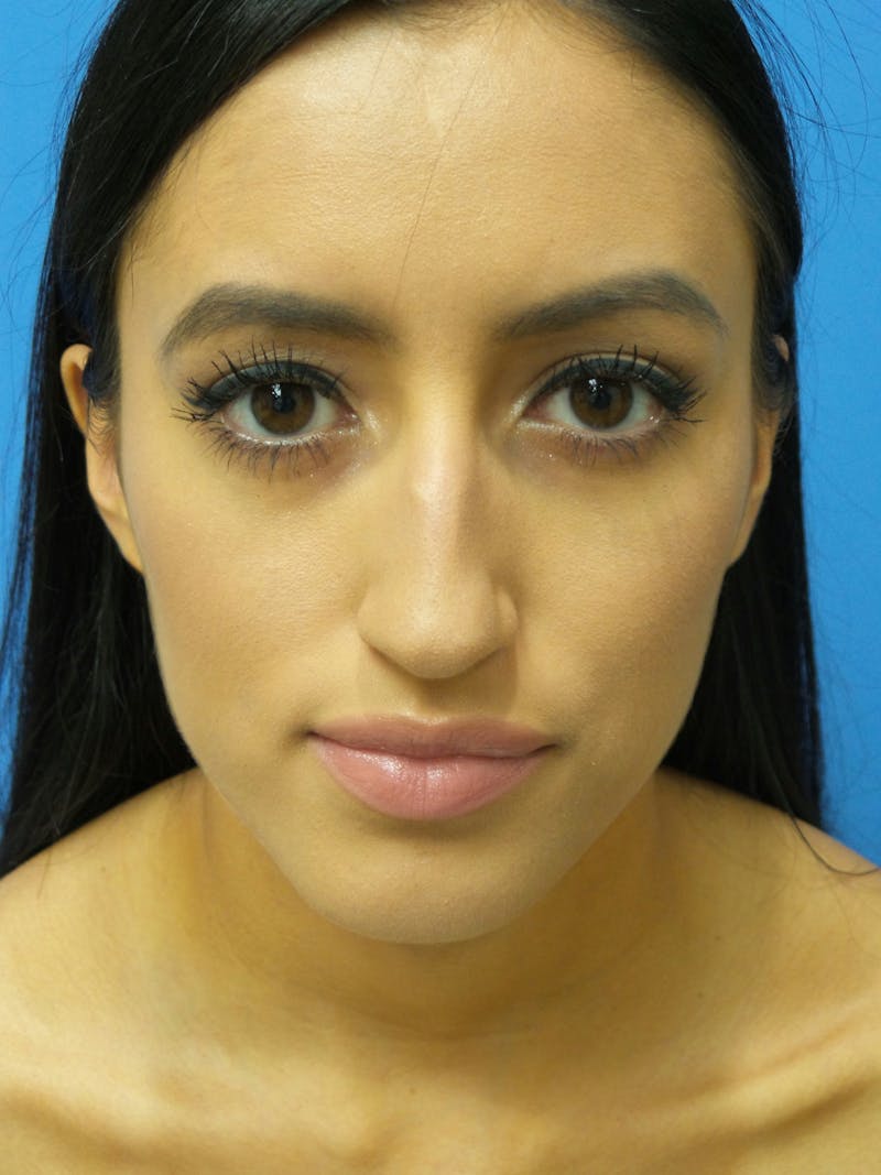 Rhinoplasty Before & After Gallery - Patient 102743 - Image 5