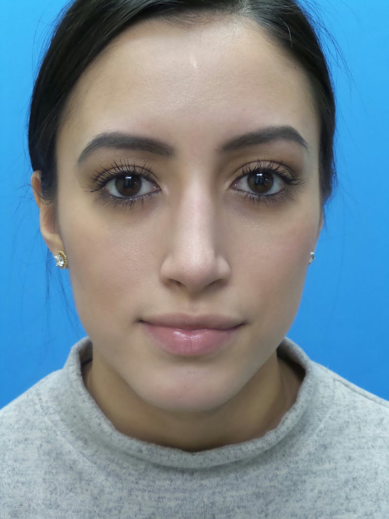 Rhinoplasty Before & After Gallery - Patient 102743 - Image 6
