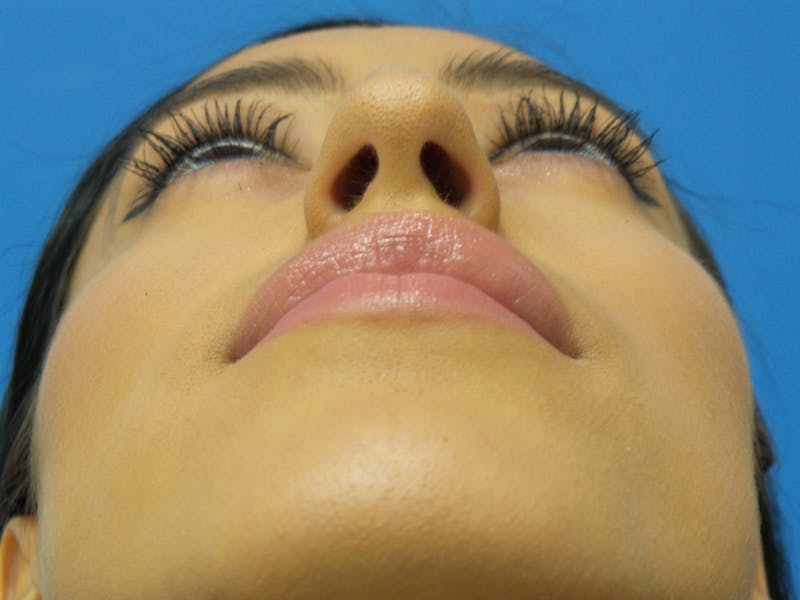 Rhinoplasty Before & After Gallery - Patient 102743 - Image 7