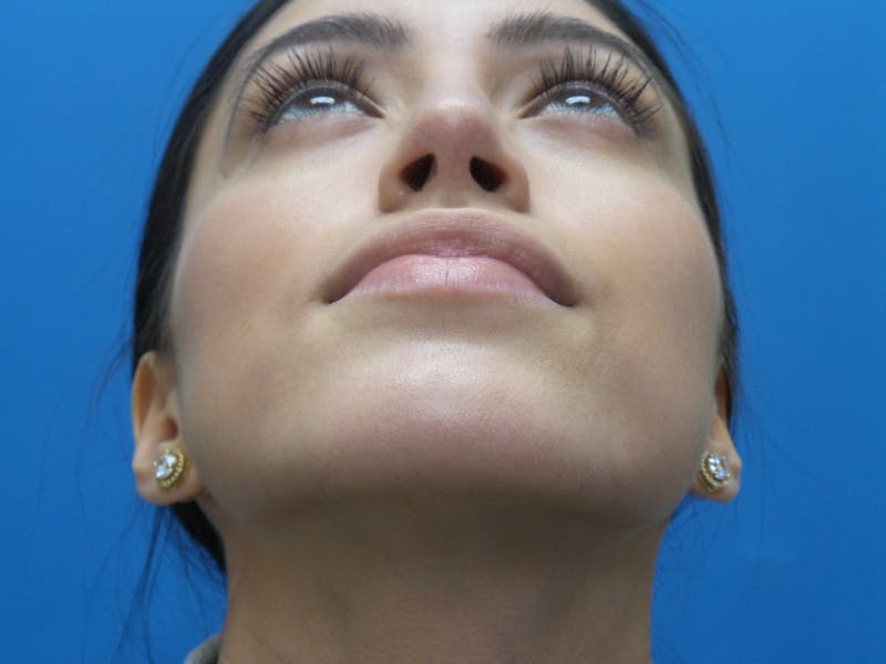 Rhinoplasty Before & After Gallery - Patient 102743 - Image 8