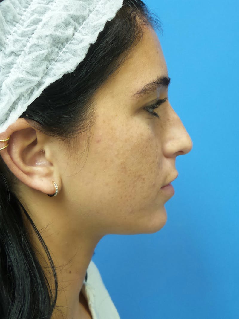 Rhinoplasty Before & After Gallery - Patient 119011 - Image 1