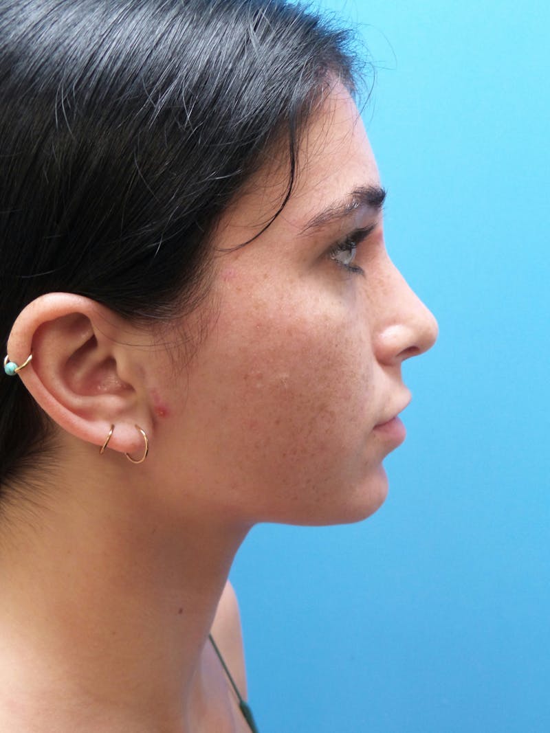 Rhinoplasty Before & After Gallery - Patient 119011 - Image 2