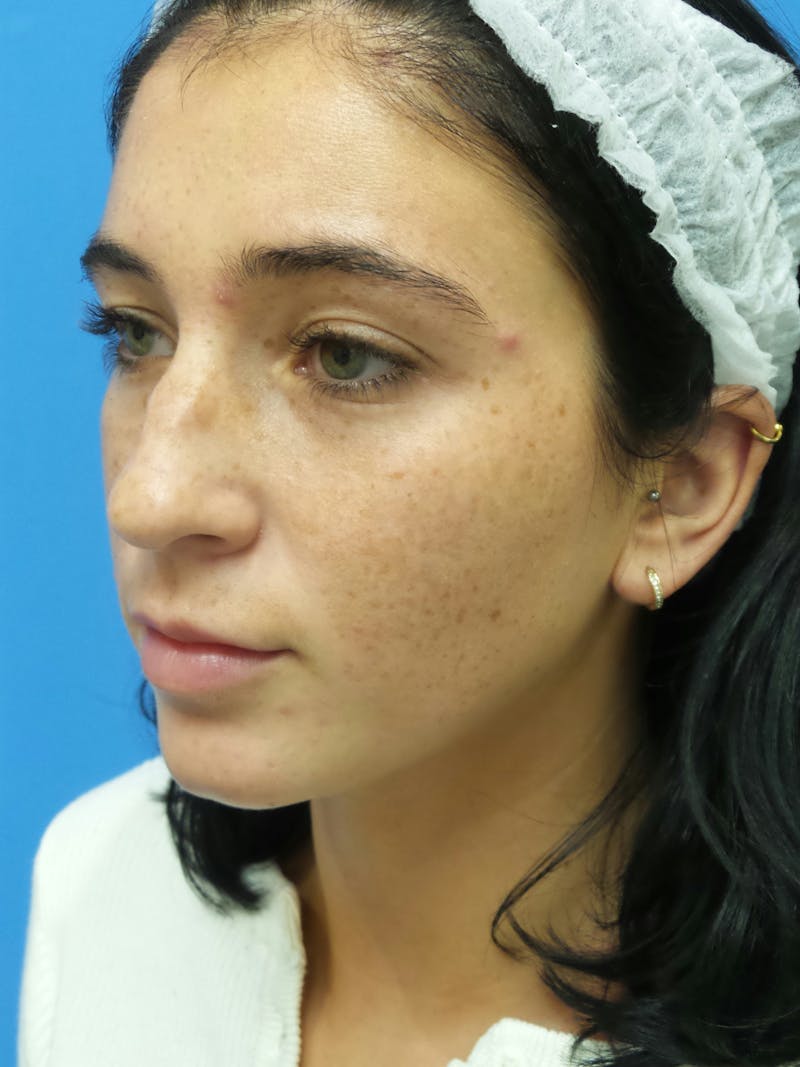 Rhinoplasty Before & After Gallery - Patient 119011 - Image 3