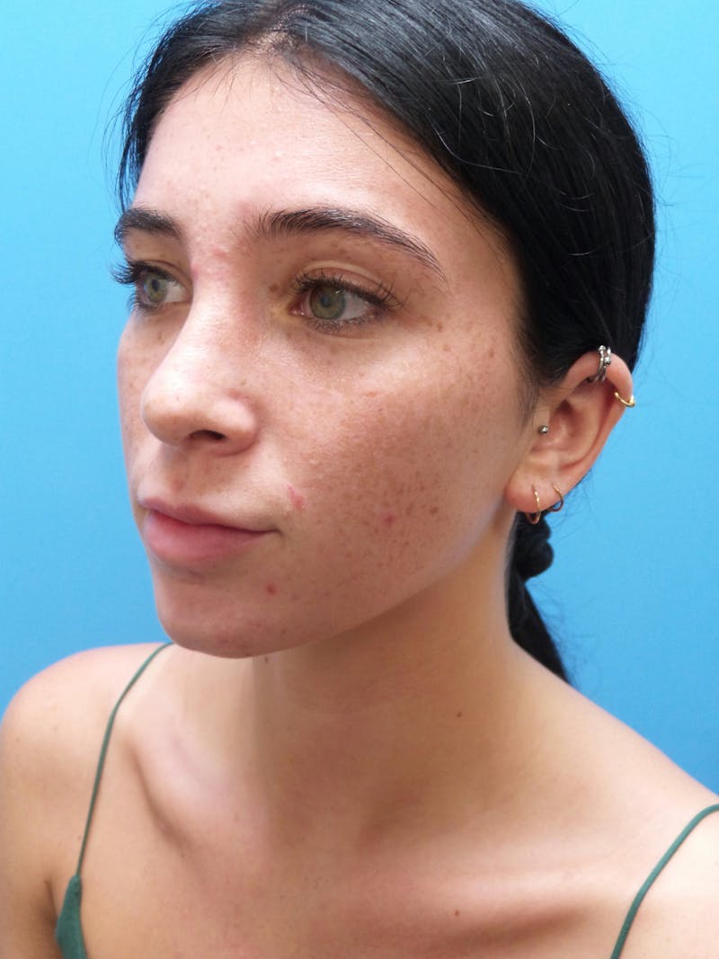 Rhinoplasty Before & After Gallery - Patient 119011 - Image 4