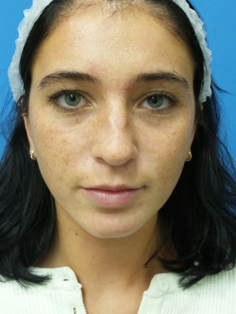 Rhinoplasty Before & After Gallery - Patient 119011 - Image 5