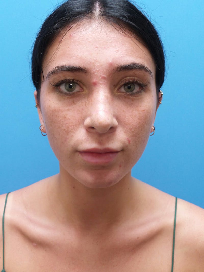 Rhinoplasty Before & After Gallery - Patient 119011 - Image 6